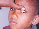 Child being screened 
